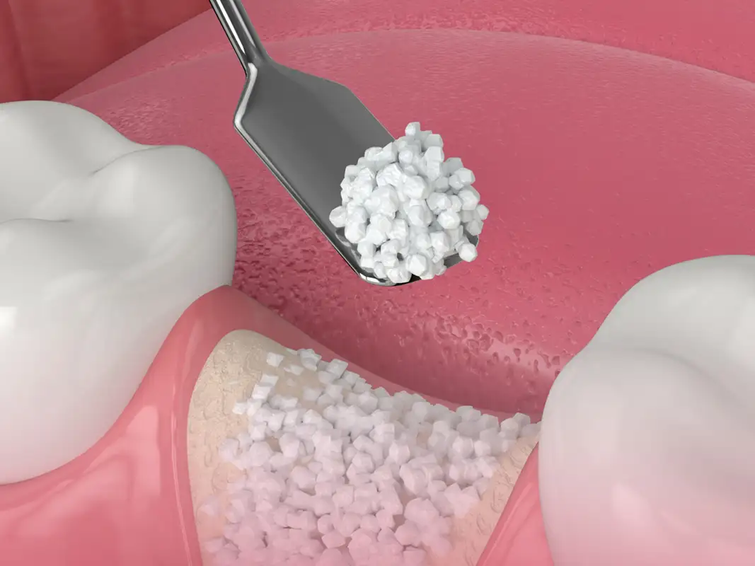 bone grafting 3D model