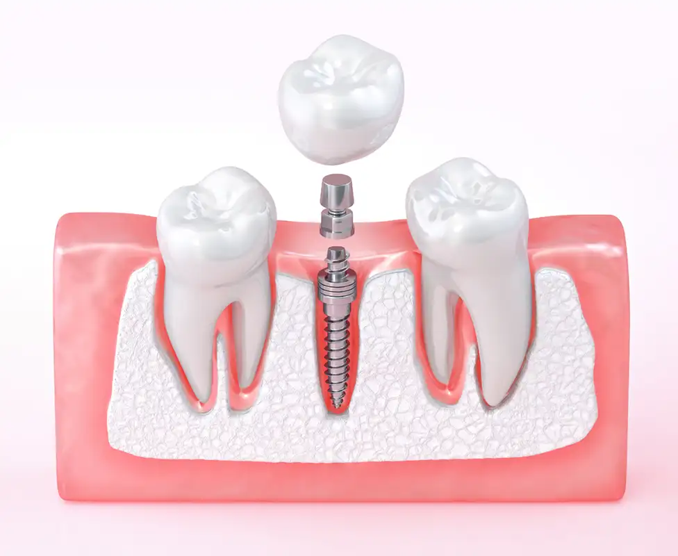 3D model illustration of a dental implant